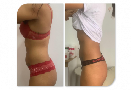 Enzimas + Cavitação