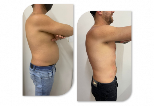 Tratamento para Gordura localizada