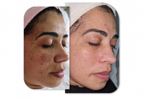 Clareamento de Melasma